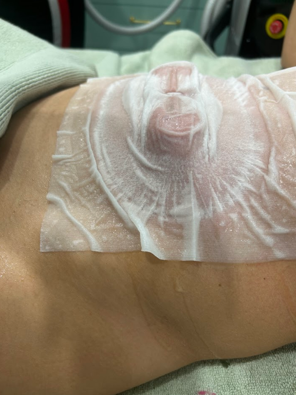 Application d’un masque de cryolipolyse sur la zone abdominale pour traitement minceur non invasif